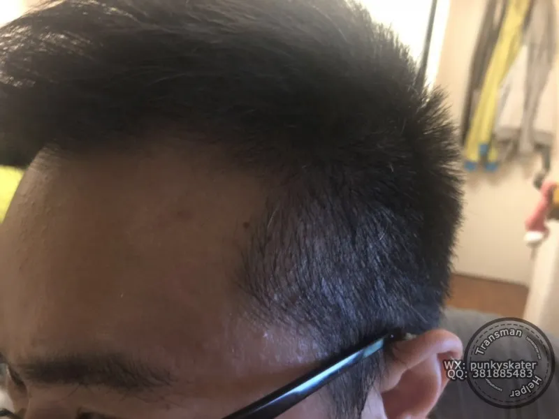 跨男睾酮激素治疗 5 年左侧发际线